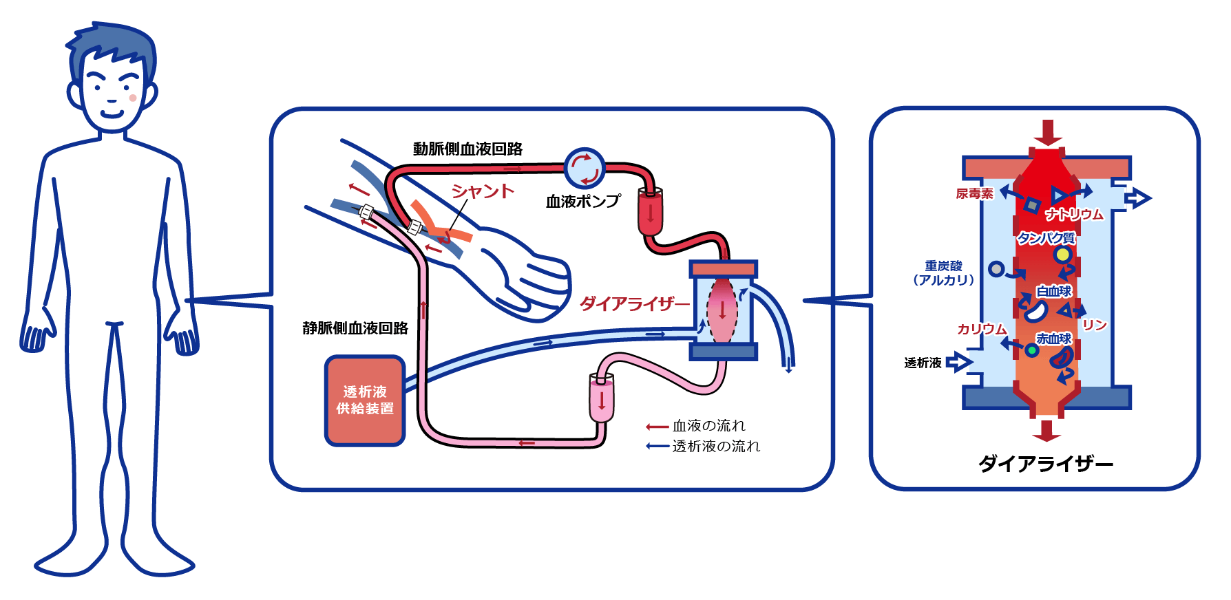 シャント部に刺した針から、血液がダイアライザーにおくられます