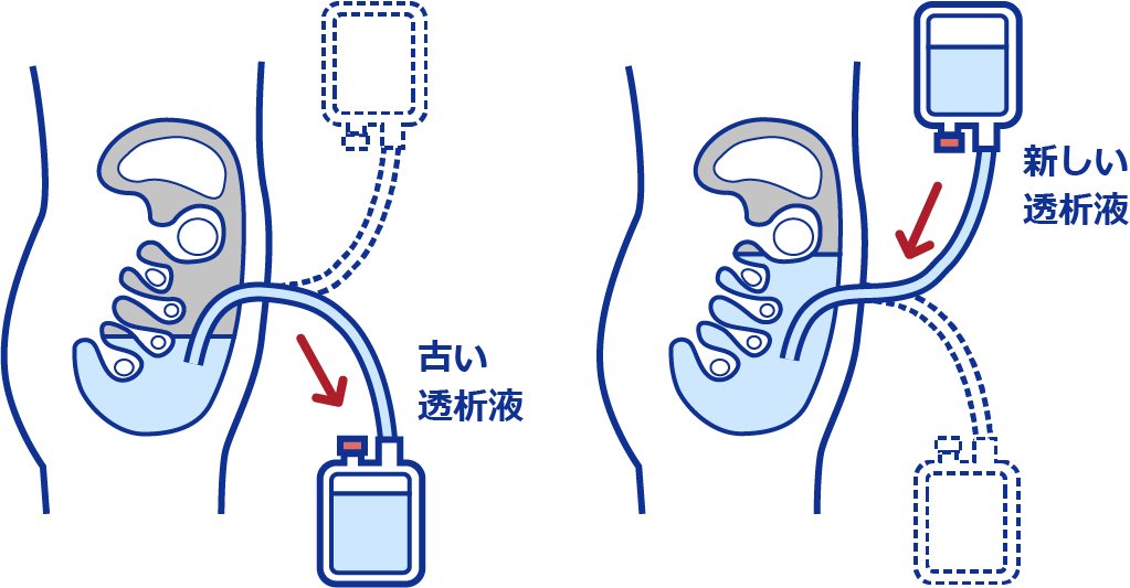 腹腔内に透析液を入れておく