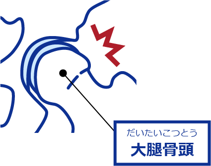大腿骨頭と骨盤のすき間が狭くなり、骨の一部が直接ぶつかる