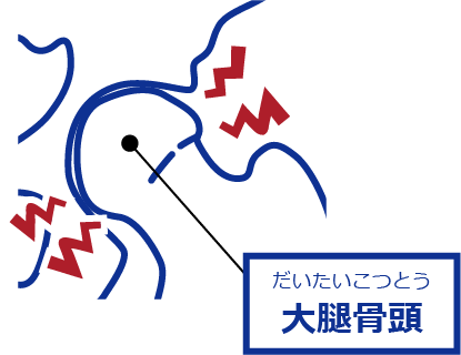 大腿骨頭と骨盤のすき間が消失
