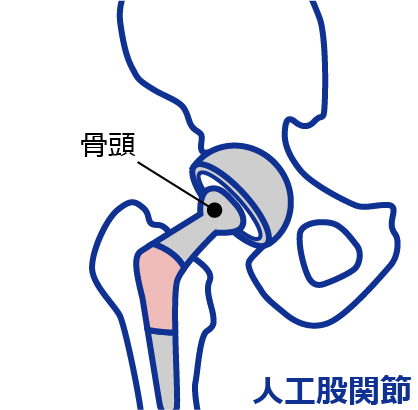 人工股関節置換術のイラスト