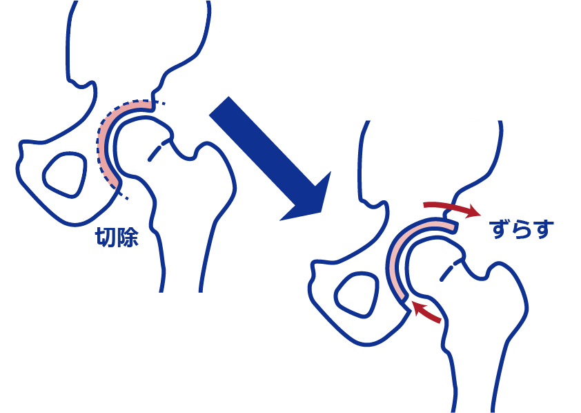 骨切り術のイラスト
