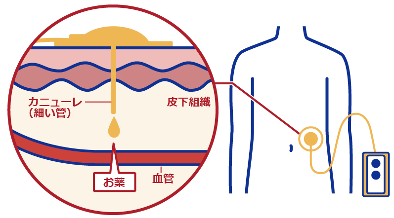 持続皮下注療法